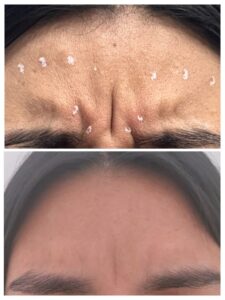 Comparativa antes y después de tratamiento con toxina botulínica en entrecejo, eliminación de líneas de expresión profundas con bótox en clínica estética Dr. Perdomo