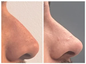 Comparativa antes y después de rinomodelación sin cirugía con ácido hialurónico en paciente masculino, corrección del dorso nasal en clínica estética Dr. Perdomo