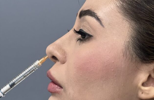 Perfil de paciente femenina recibiendo inyección de ácido hialurónico en punta nasal para rinomodelación sin cirugía en clínica estética Dr. Perdomo