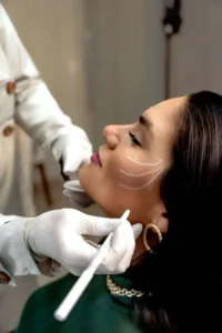 Médico trazando puntos de aplicación en rostro y mandíbula de paciente previo a tratamiento con bioestimulador de colágeno para rejuvenecimiento facial en clínica estética Dr. Perdomo