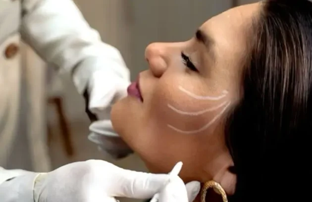 Médico trazando puntos de aplicación en rostro y mandíbula de paciente previo a tratamiento con bioestimulador de colágeno para rejuvenecimiento facial en clínica estética Dr. Perdomo