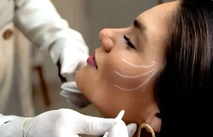 Médico trazando puntos de aplicación en rostro y mandíbula de paciente previo a tratamiento con bioestimulador de colágeno para rejuvenecimiento facial en clínica estética Dr. Perdomo