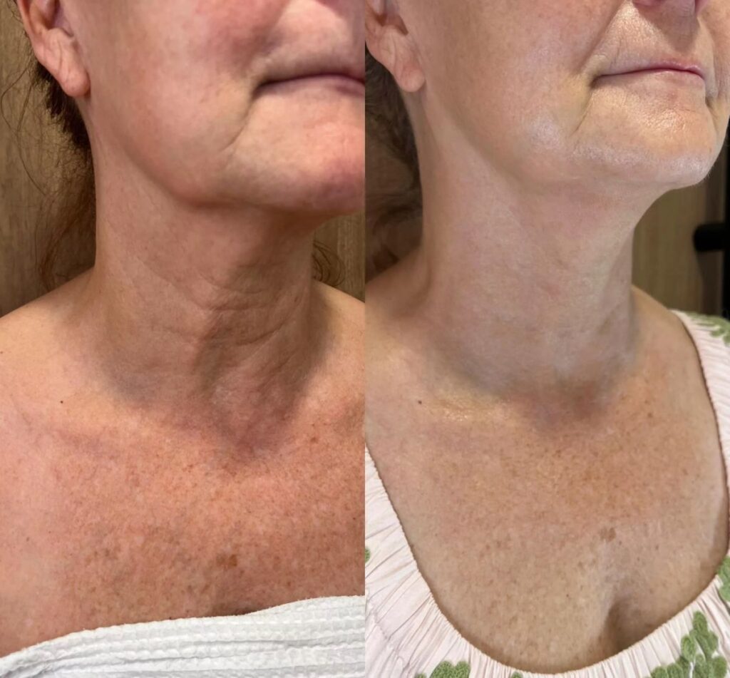 Comparativa antes y después de rejuvenecimiento de cuello y escote con Radiesse, bioestimulador de colágeno que reduce flacidez y arrugas cervicales en clínica estética Dr. Perdomo