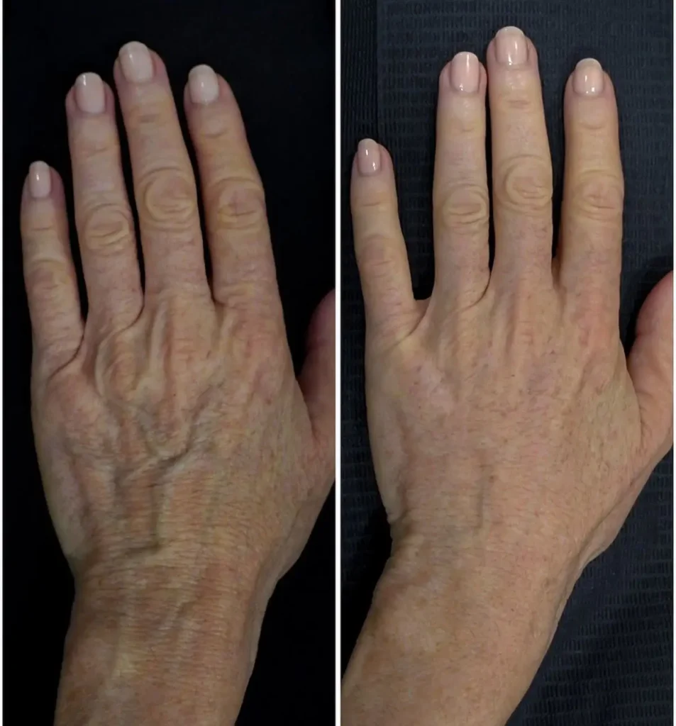 Comparativa antes y después de rejuvenecimiento de manos con Radiesse, bioestimulador de colágeno que reduce venas y arrugas visibles en clínica estética Dr. Perdomo