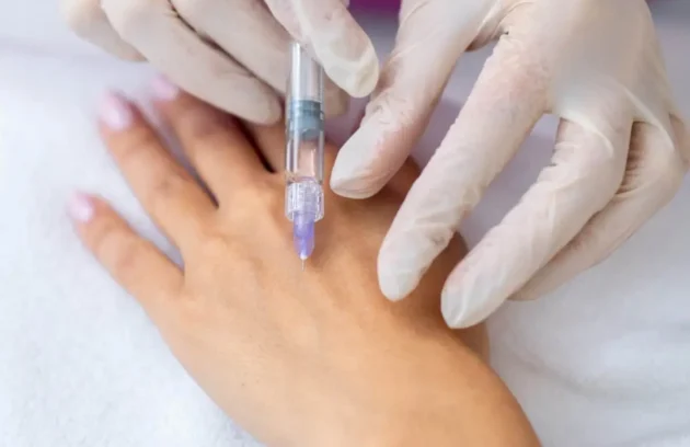 Médico aplicando inyección de Radiesse con bioestimulador de colágeno en dorso de mano para rejuvenecimiento y reducción de flacidez en clínica estética Dr. Perdomo