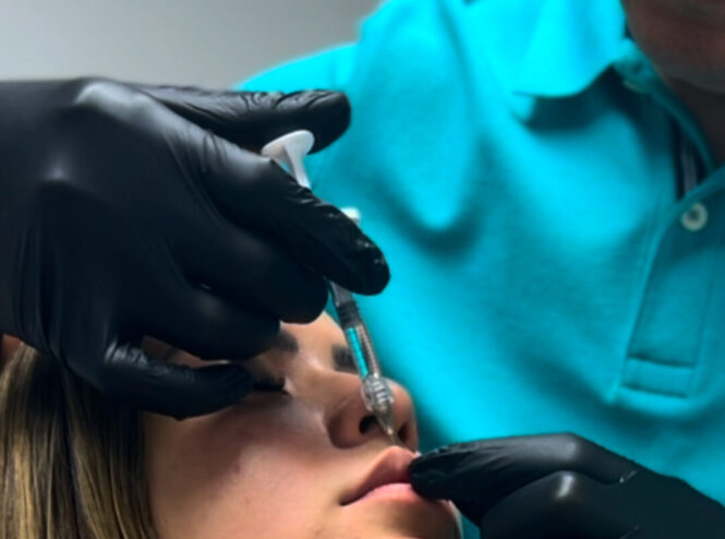 Dr. Perdomo aplicando relleno dérmico con ácido hialurónico en labios de paciente, tratamiento estético natural sin efecto cara congelada en clínica Dr. Perdomo