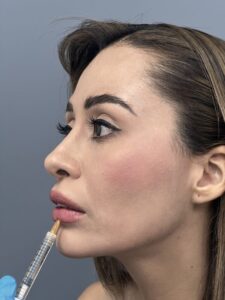 Aplicación de relleno de ácido hialurónico en labios de paciente femenina de perfil, tratamiento de rinomodelación y aumento de labios en clínica estética Dr. Perdomo