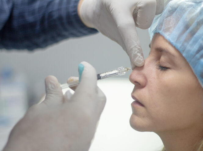 Procedimiento de rinomodelación con inyección de relleno en dorso nasal sin cirugía