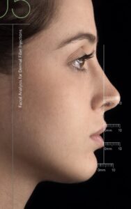 Análisis facial de perfil con medidas para planificación de armonización facial con rellenos dérmicos