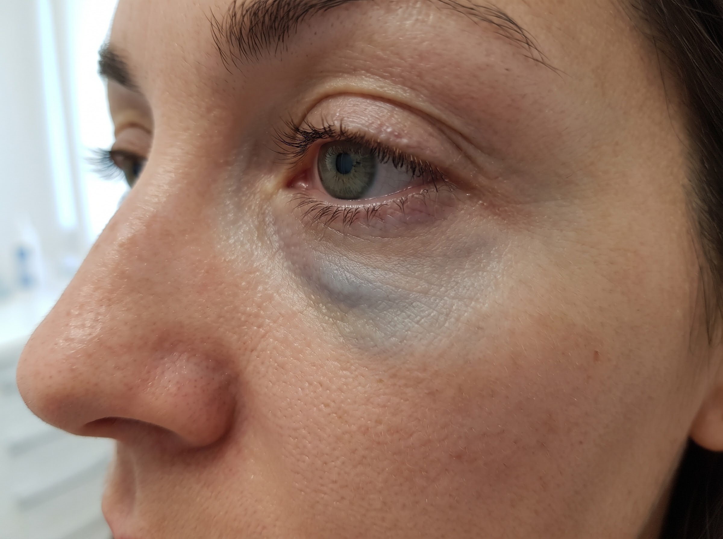 Coloración azulada bajo el ojo (efecto Tyndall) por relleno de ácido hialurónico superficial en ojeras