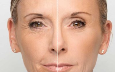 Antes y después de armonización facial con reducción visible de arrugas y rejuvenecimiento