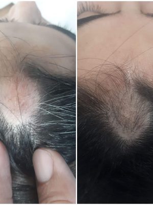 Antes y después de tratamiento de cicatriz en cuero cabelludo con Dr. Perdomo