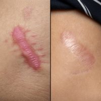 Reducción de cicatriz queloide antes y después de tratamiento