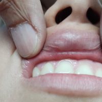 Complicación por relleno facial en labio superior antes de tratamiento correctivo
