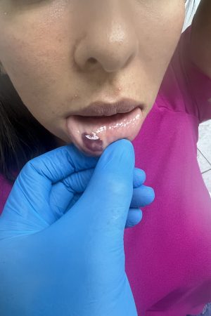 Tratamiento de complicaciones por rellenos faciales en El Salvador