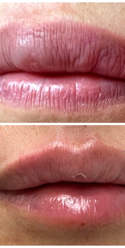 Antes y después de tratamiento de complicación por relleno en labios con Dr. Perdomo