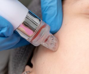 Extracción de impurezas con equipo de succión durante limpieza facial profunda