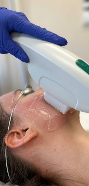 Tratamiento de fotorrejuvenecimiento con luz pulsada IPL en rostro en clínica Dr. Perdomo