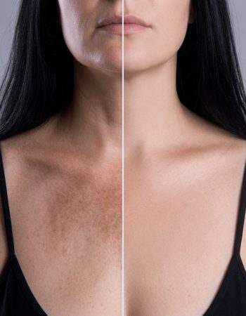 Fotorrejuvenecimiento con IPL en El Salvador | Dr. Perdomo