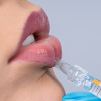 Inyección de ácido hialurónico en labio inferior para aumento y definición de labios