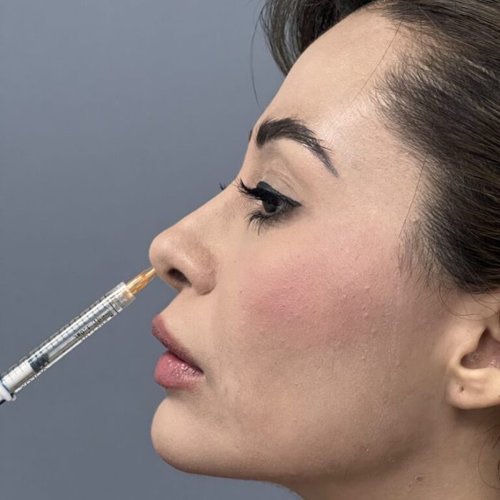 Perfil de paciente femenina recibiendo inyección de ácido hialurónico en punta nasal para rinomodelación sin cirugía en clínica estética Dr. Perdomo